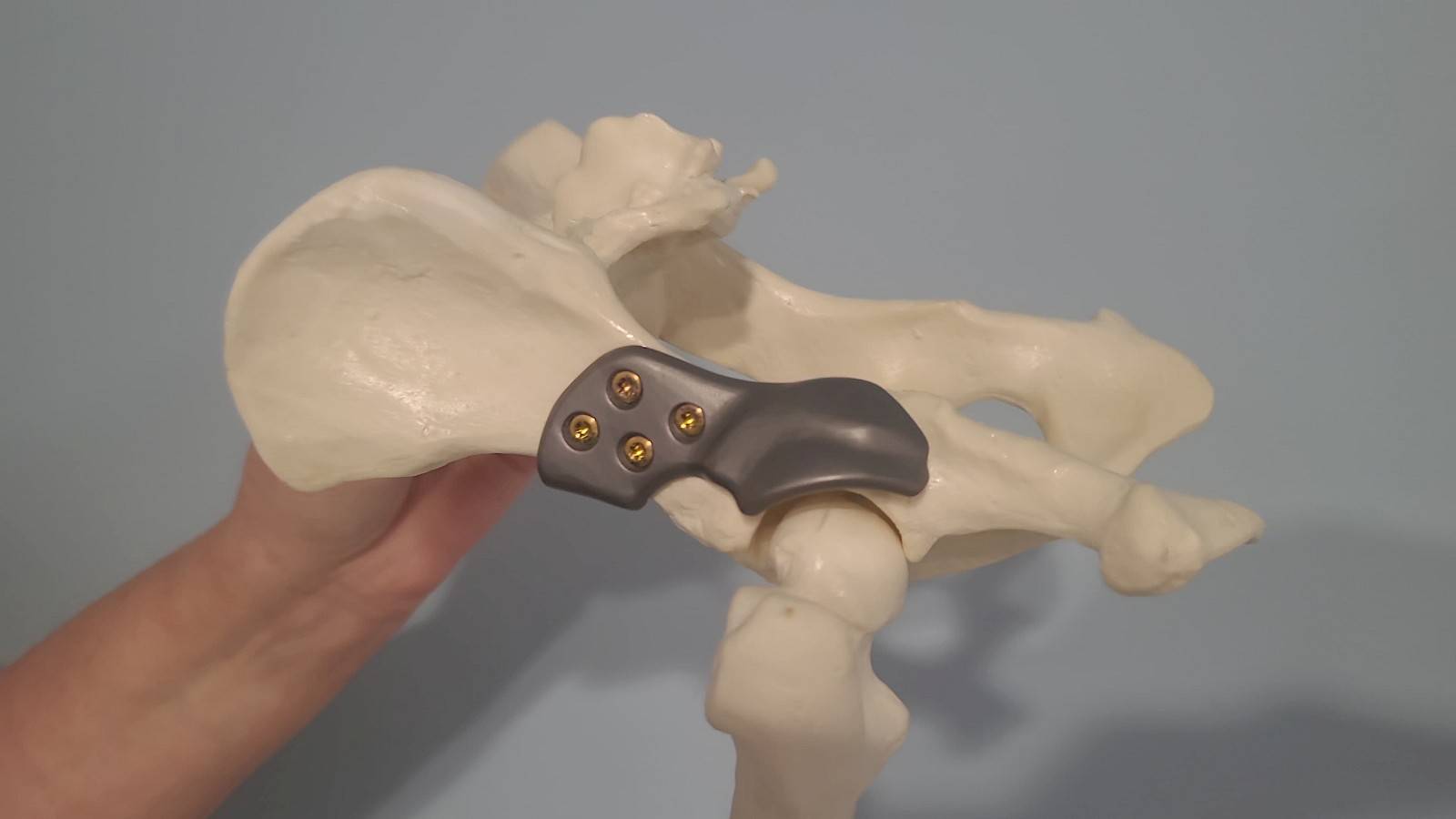 3D-geprinte titanium heupimplantaat voor beagle Mauro